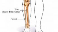 Fractura Severo de Pierna- Tibia y Peroné
